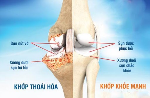 Hình ảnh của khớp khỏe mạnh và khớp thoái hóa