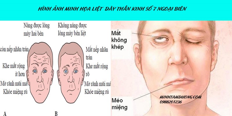 Hình ảnh minh họa của bệnh liệt dây thần kinh số 7