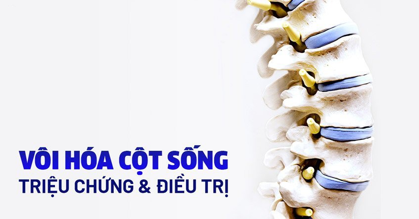 Vôi hóa cột sống: nguyên nhân, triệu chứng, chẩn đoán và điều trị
