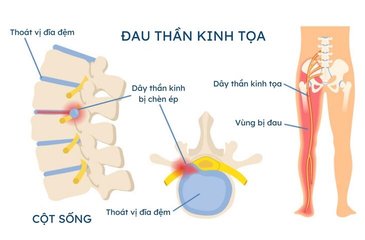Đau dây thần kinh tọa phổ biến ở nhiều lứa tuổi