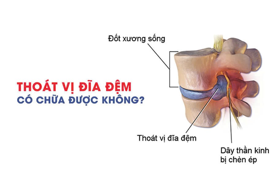 Thoát vị đĩa đệm