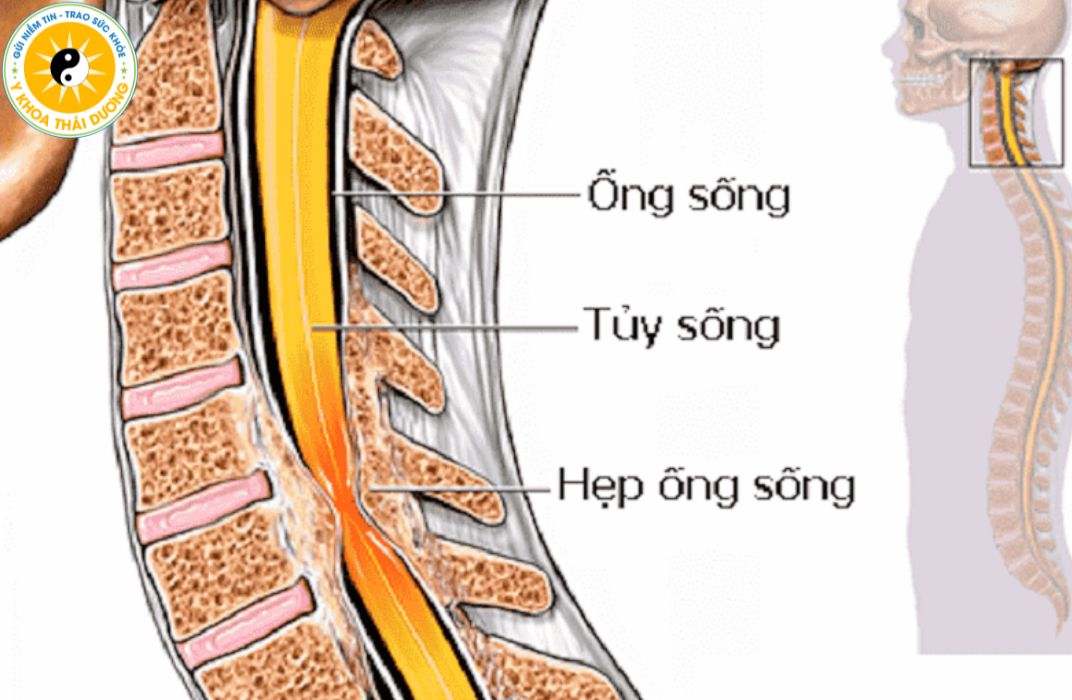 Các bệnh về cột sống thường gặp: Dấu hiệu bệnh và phương pháp phòng ngừa
