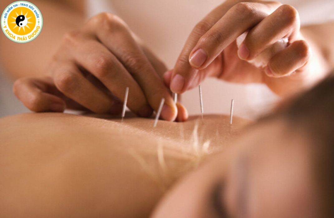 Châm cứu có tác dụng gì? Ai nên và ai không nên thực hiện?