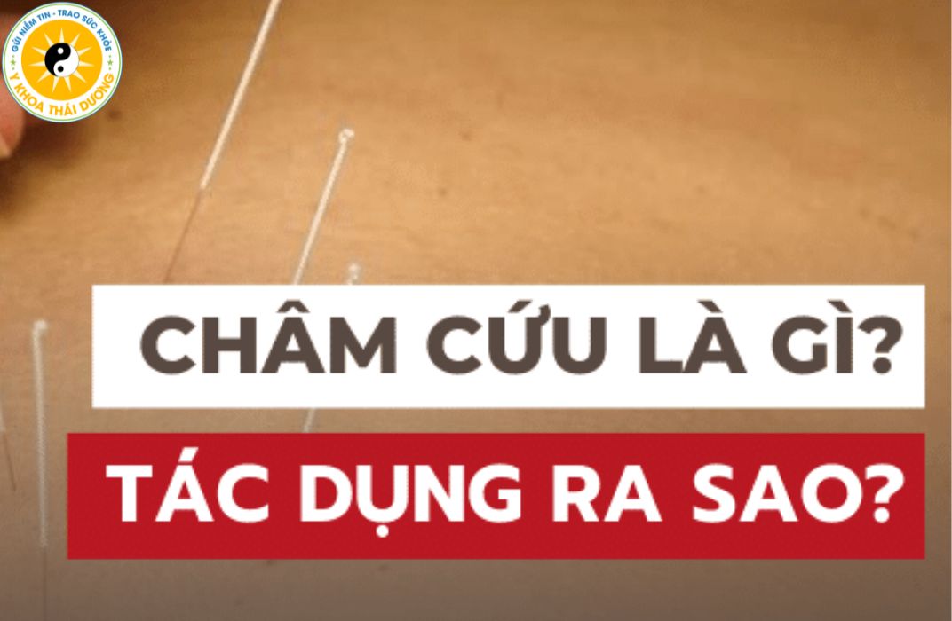 Châm cứu có tác dụng gì? Ai nên và ai không nên thực hiện?