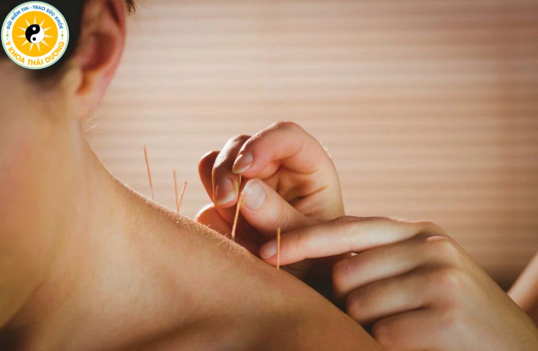 Châm cứu có tác dụng gì? Ai nên và ai không nên thực hiện?