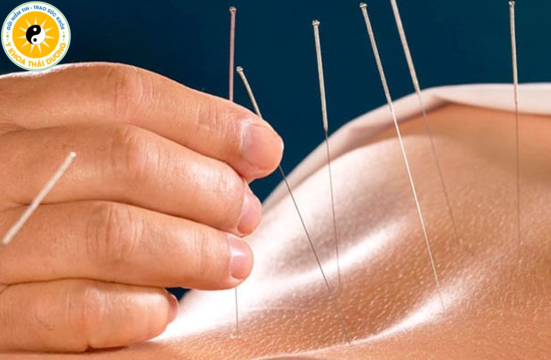 Châm cứu trong điều trị đau thần kinh tọa: Có nên áp dụng và lưu ý