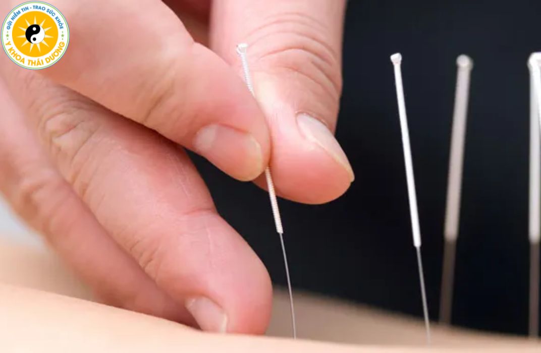 Châm cứu điều trị đau nhức xương khớp có hiệu quả không?