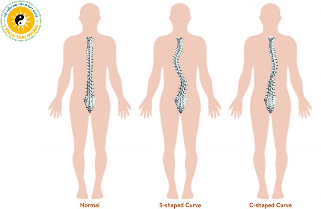 Cong vẹo cột sống: Nguyên nhân, triệu chứng và cách điều trị hiệu quả