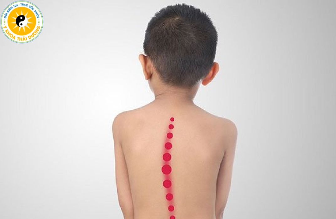 Cong vẹo cột sống: Nguyên nhân, triệu chứng và cách điều trị hiệu quả