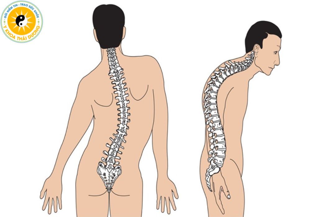 Cong vẹo cột sống: Nguyên nhân, triệu chứng và cách điều trị hiệu quả