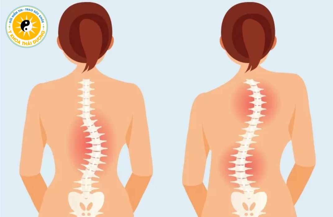 Cong vẹo cột sống: Nguyên nhân, triệu chứng và cách điều trị hiệu quả