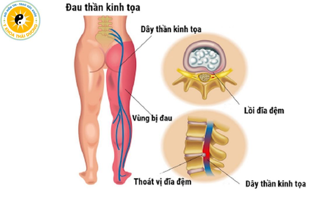 Đau thần kinh tọa