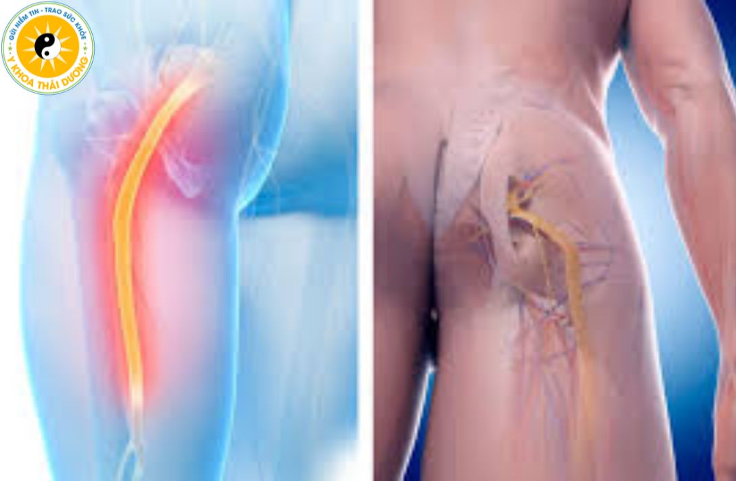 Đau thần kinh tọa: Nên ăn gì, kiêng gì để hỗ trợ giảm đau nhanh