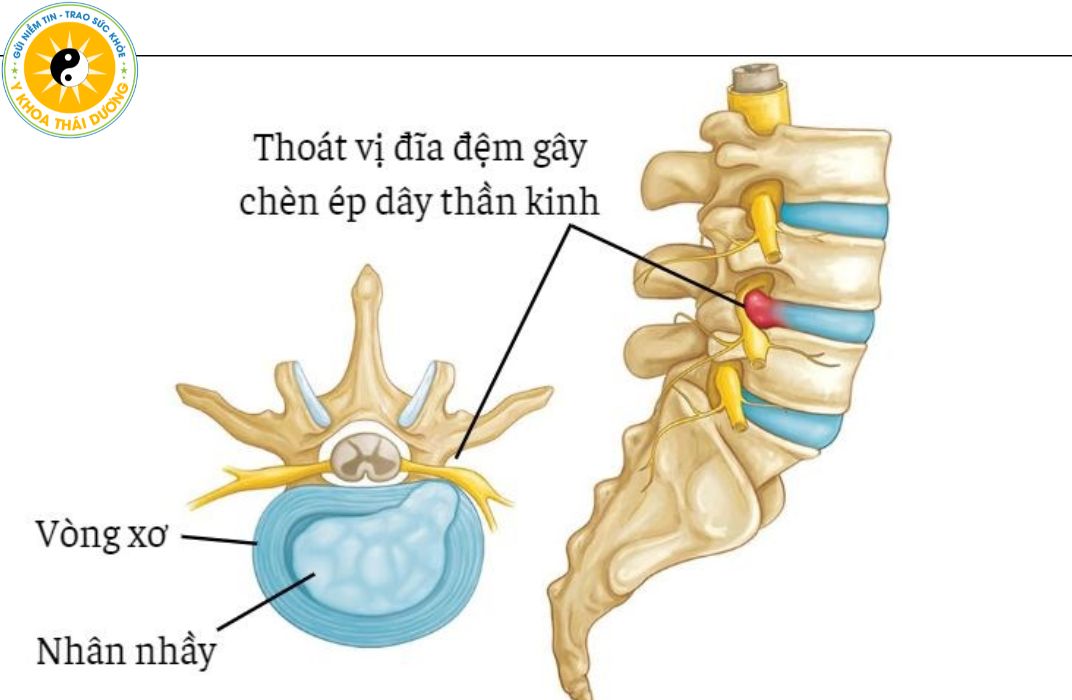 Đau thần kinh tọa: Cách nhận biết sớm và giải pháp điều trị chuẩn y khoa