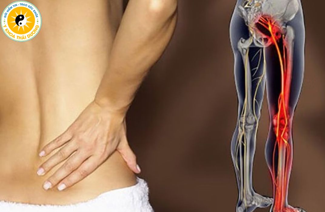 Đau thần kinh tọa: Cách nhận biết sớm và giải pháp điều trị chuẩn y khoa
