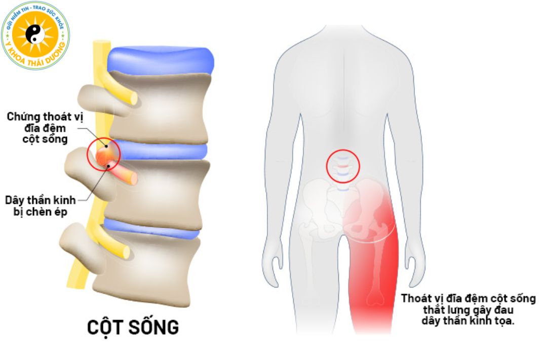Châm cứu trong điều trị đau thần kinh tọa: Có nên áp dụng và lưu ý