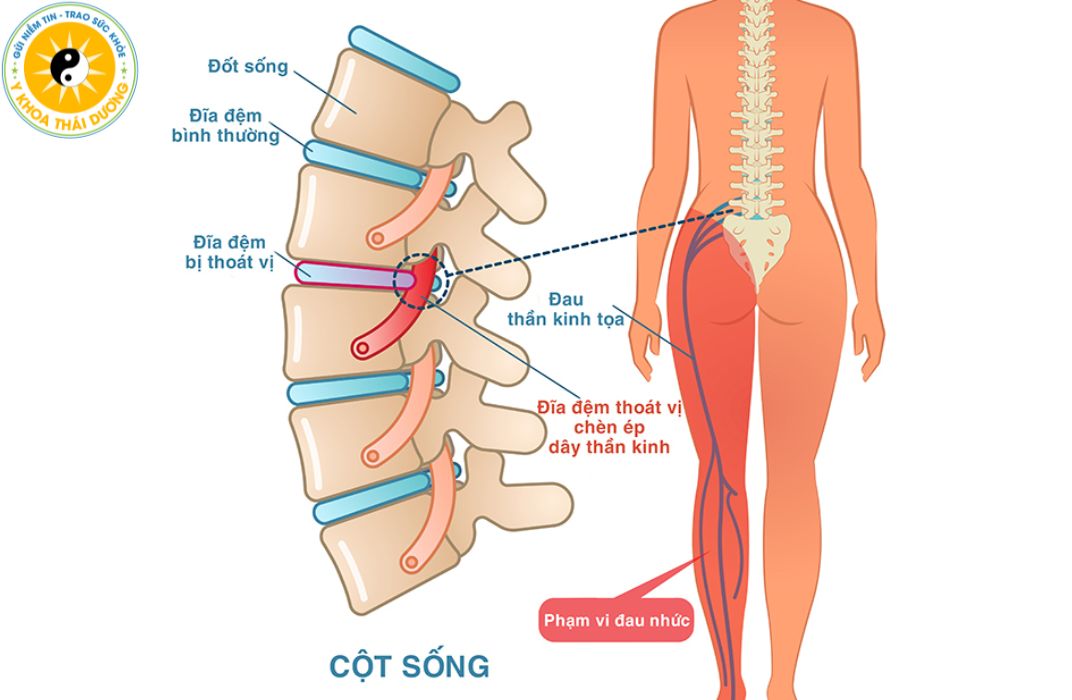 Đau thần kinh tọa kéo dài: Cảnh báo bệnh lý cột sống và hướng điều trị hiệu quả