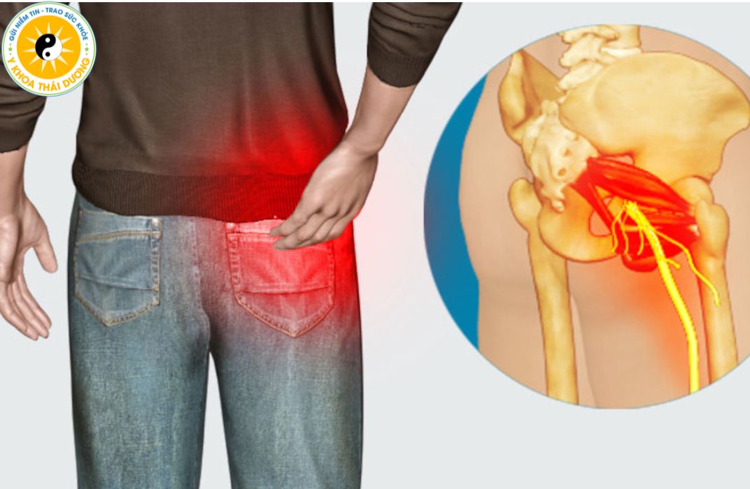 Đau thần kinh tọa kéo dài: Cảnh báo bệnh lý cột sống và hướng điều trị hiệu quả
