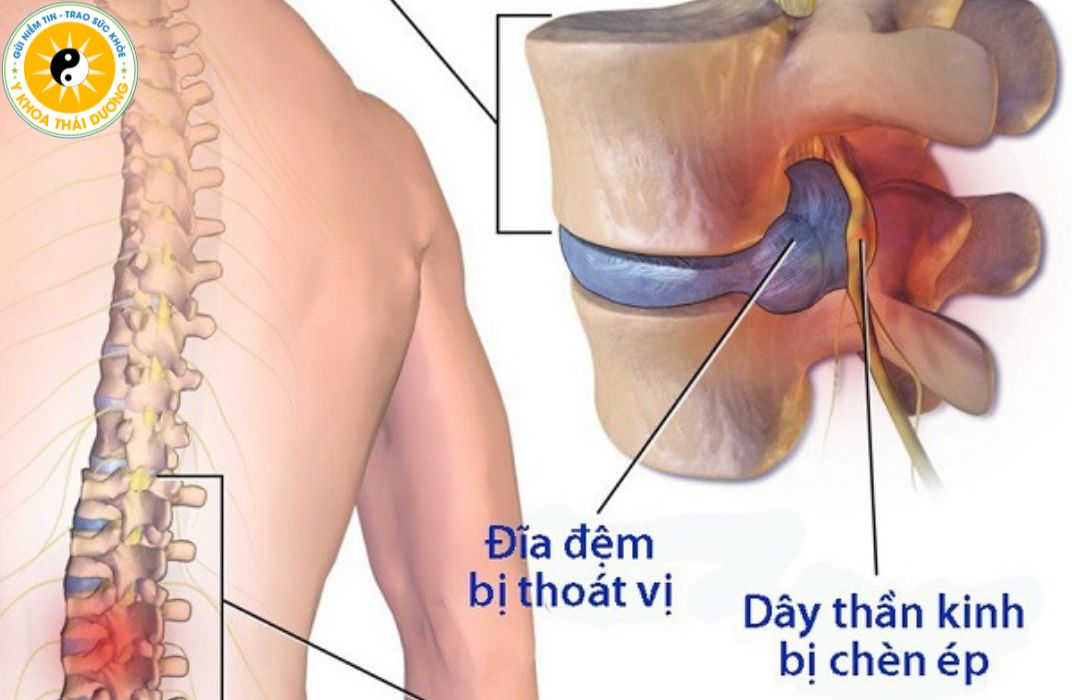Đau thần kinh tọa là gì? Nguyên nhân, mức độ nguy hiểm và cách điều trị