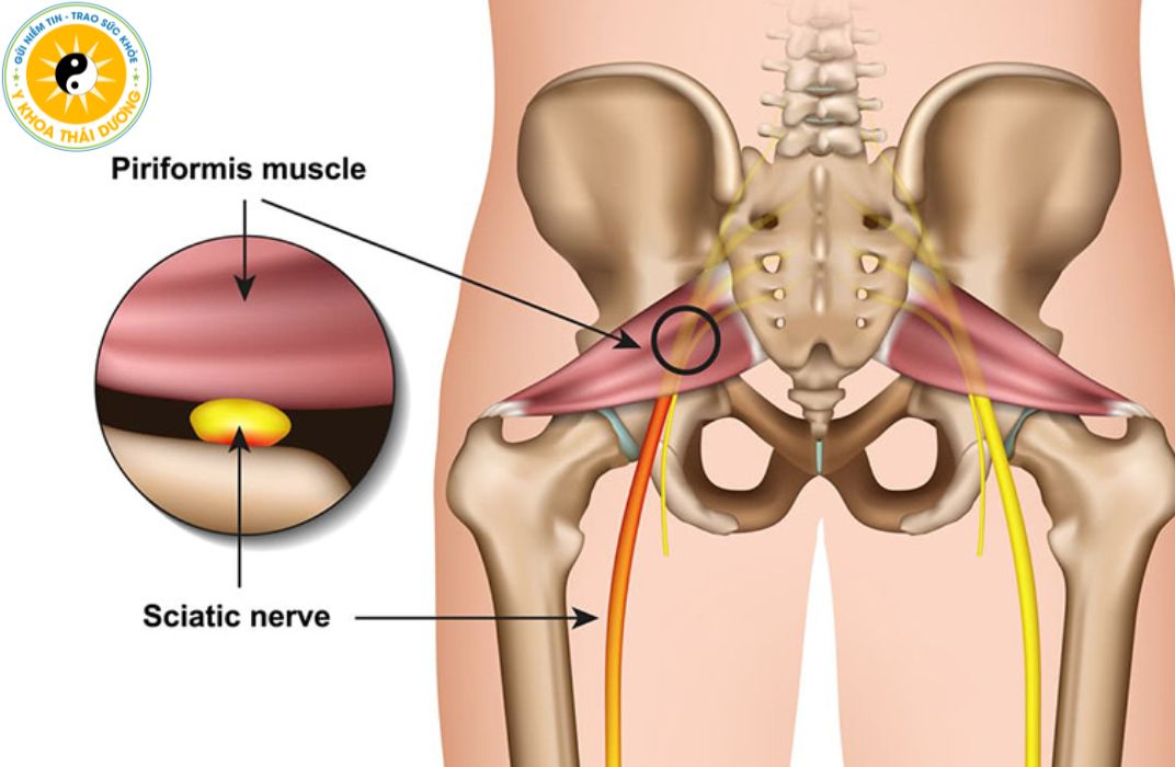 Đau thần kinh tọa và hội chứng Piriformi: Cách nhận biết và phân biệt nhanh chóng