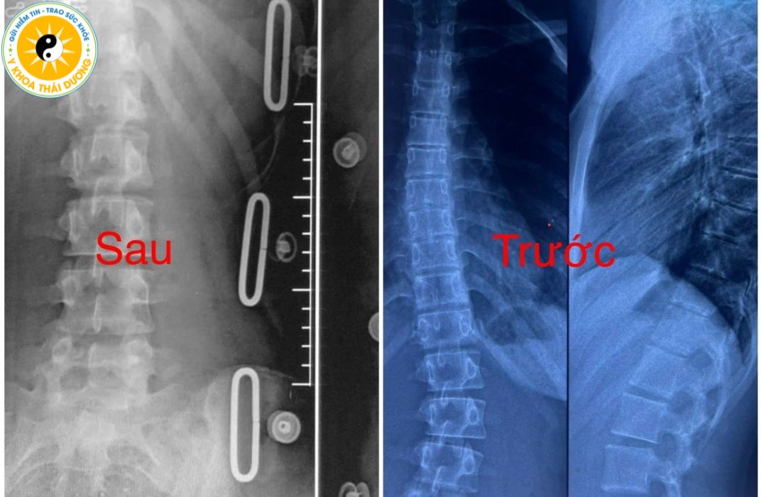 Vì sao học sinh dễ bị cong vẹo cột sống? Nguyên nhân, dấu hiệu nhận biết