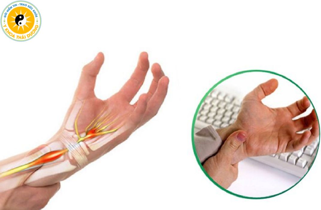 Hội chứng ống cổ tay: Những biến chứng nguy hiểm