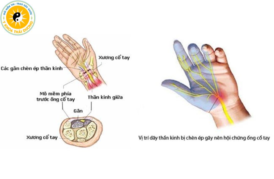 Hội chứng ống cổ tay: Những biến chứng nguy hiểm