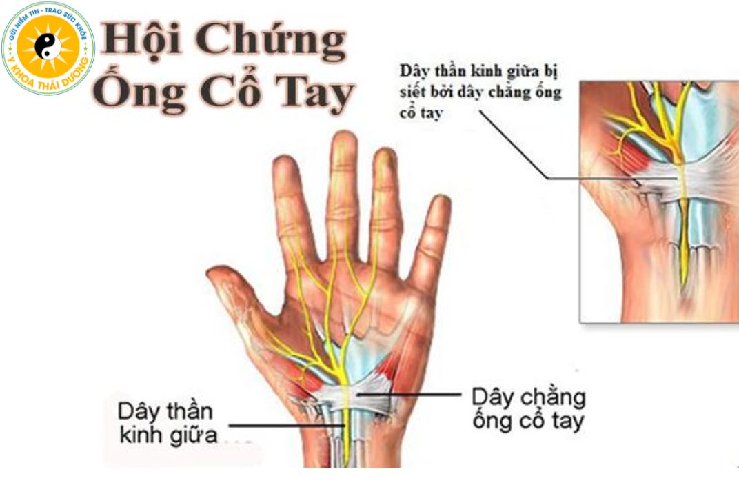 Hội chứng ống cổ tay là gì? Dấu hiệu nhận biết sớm và mức độ nguy hiểm