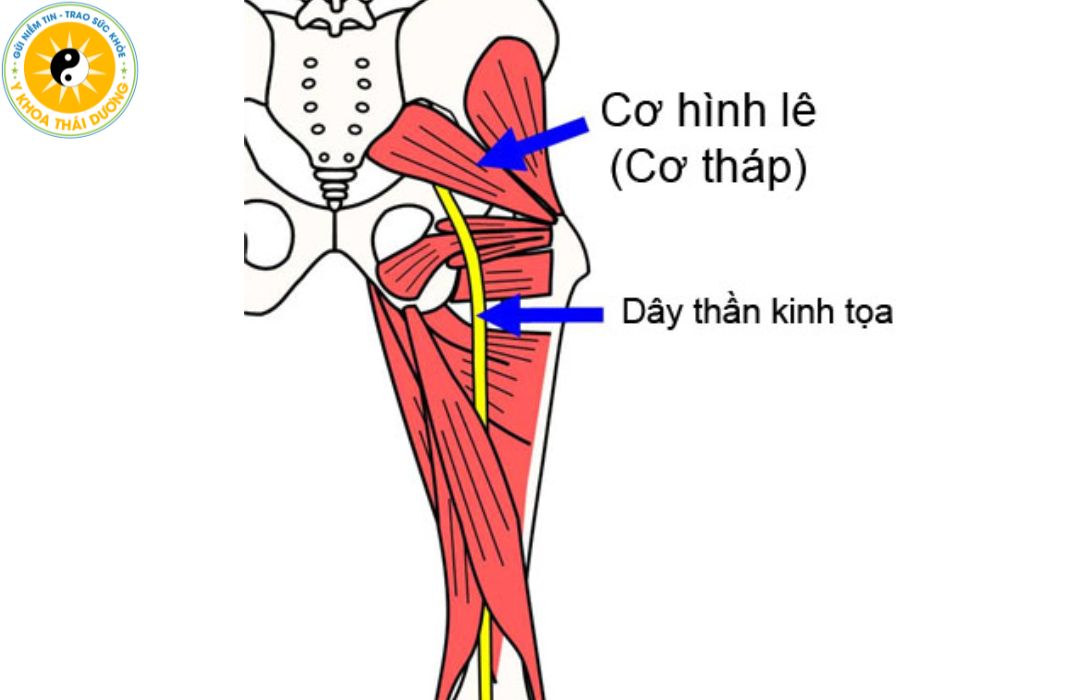 Hội chứng Piriformis: Triệu chứng và hướng điều trị