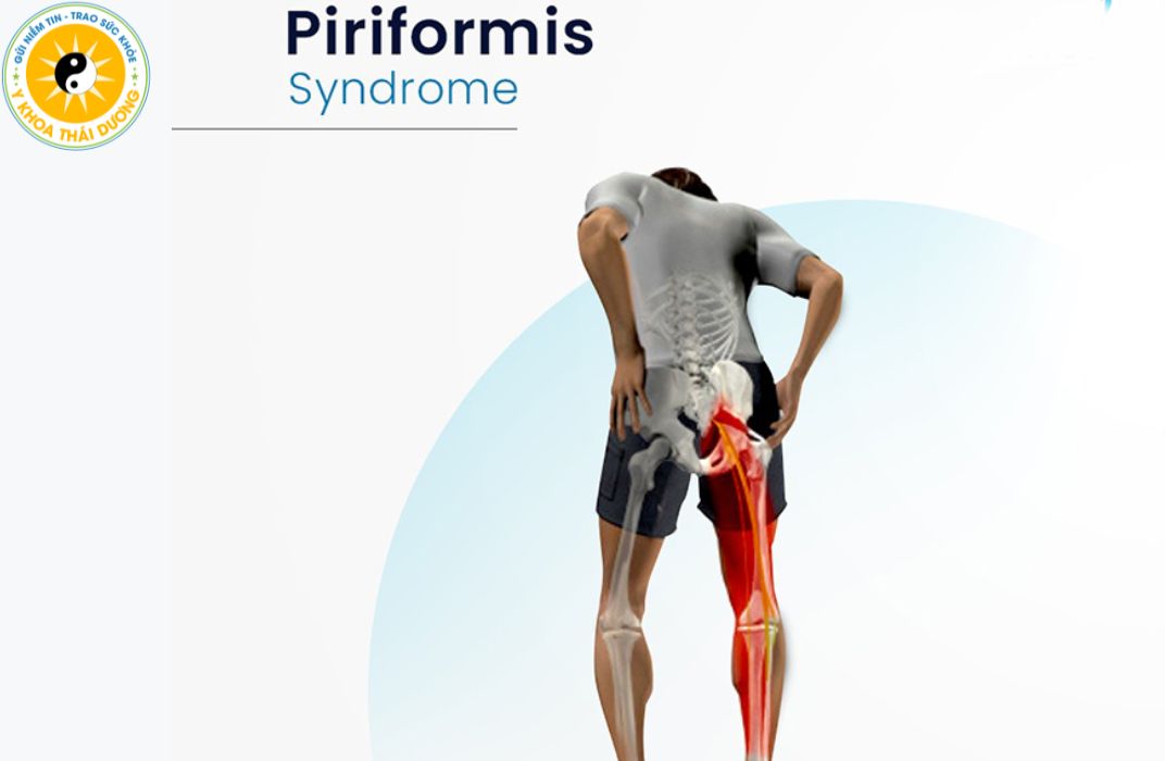 Hội chứng Piriformis: Triệu chứng và hướng điều trị