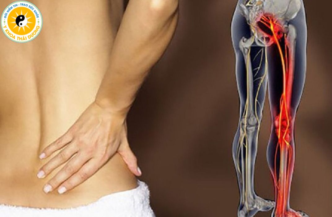 Hội chứng Piriformis: Triệu chứng và hướng điều trị