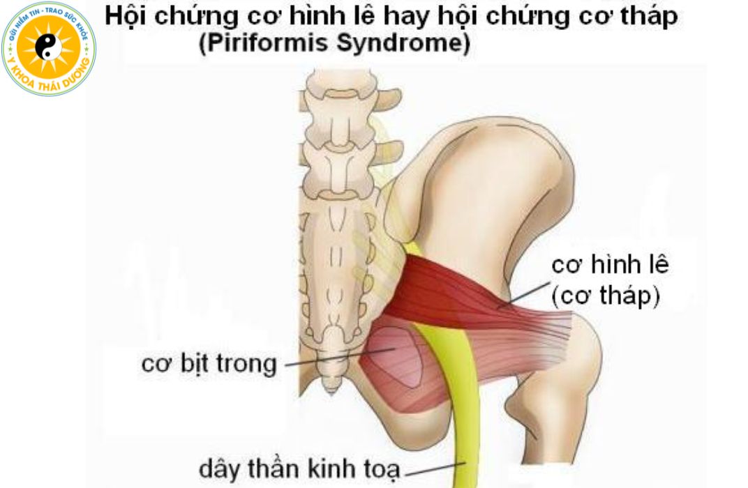 Điều trị Hội chứng Piriformis tại Phòng khám Y khoa Thái Dương