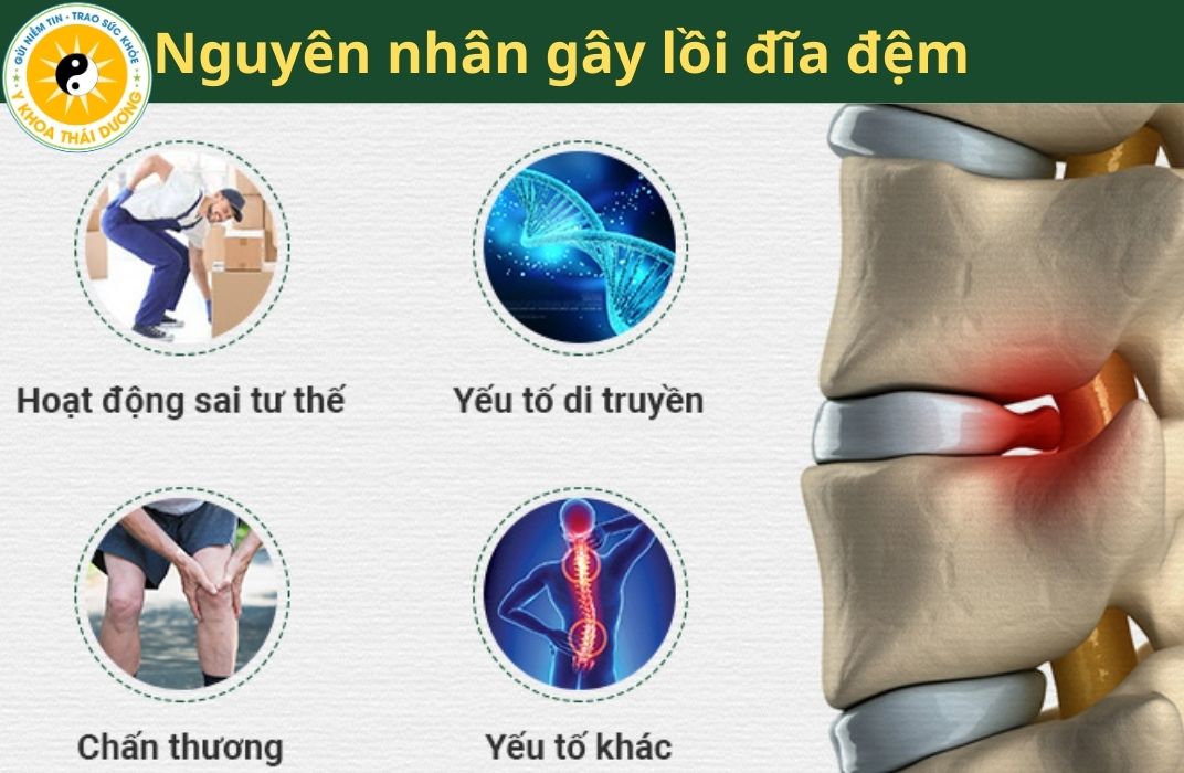 Lồi đĩa đệm: Nguyên nhân, hậu quả và cách phòng tránh