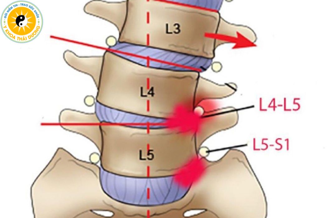 Lồi đĩa đệm: Nguyên nhân, hậu quả và cách phòng tránh