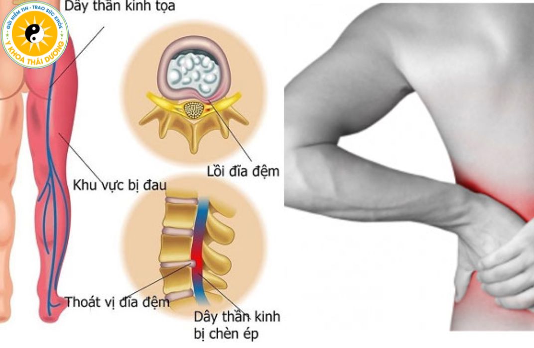 Lồi đĩa đệm: Nguyên nhân, hậu quả và cách phòng tránh