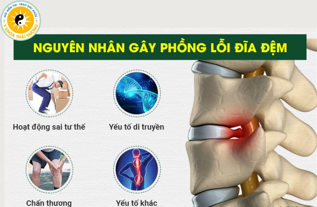 Nguyên nhân gây phình lồi đĩa đệm là gì? Phác đồ điều trị