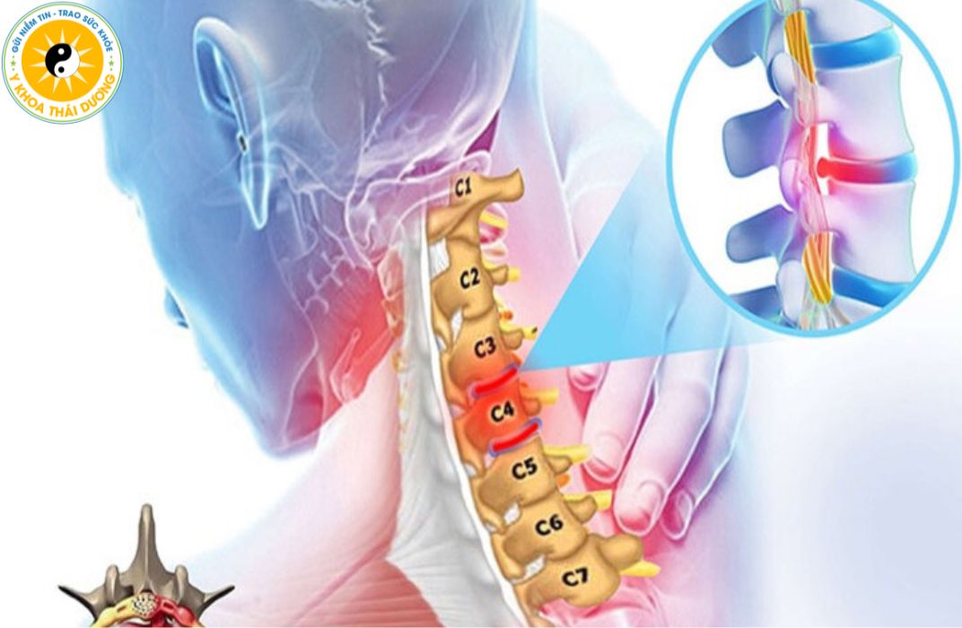 Nguyên nhân gây phình lồi đĩa đệm là gì? Phác đồ điều trị