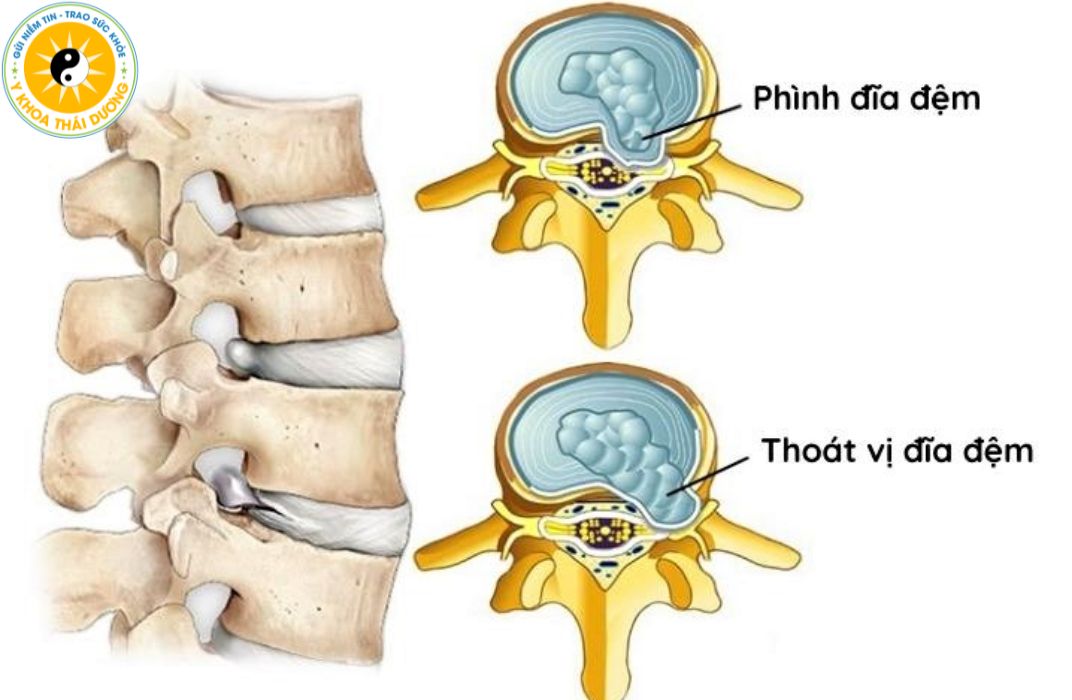Nguyên nhân gây phình lồi đĩa đệm là gì? Phác đồ điều trị
