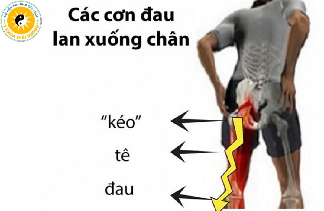 Thoái hóa cột sống: Nguyên nhân, triệu chứng và phương pháp điều trị