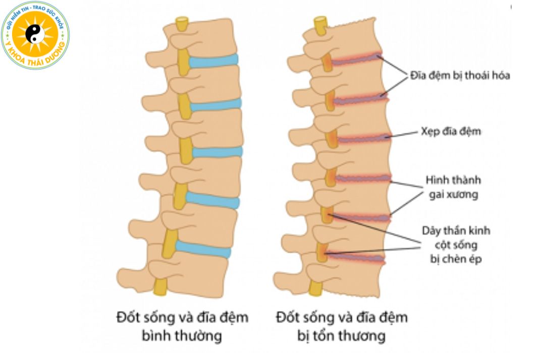 Các bệnh về cột sống thường gặp: Dấu hiệu bệnh và phương pháp phòng ngừa