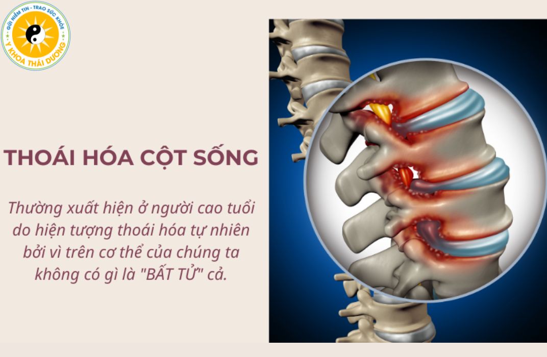 Thoái hóa cột sống: Các phương pháp điều trị không phẫu thuật