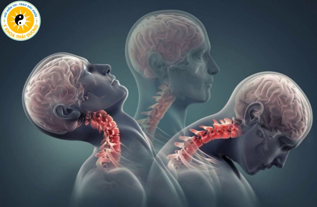 Thoái hóa cột sống thắt lưng và cổ: Triệu chứng và cách điều trị