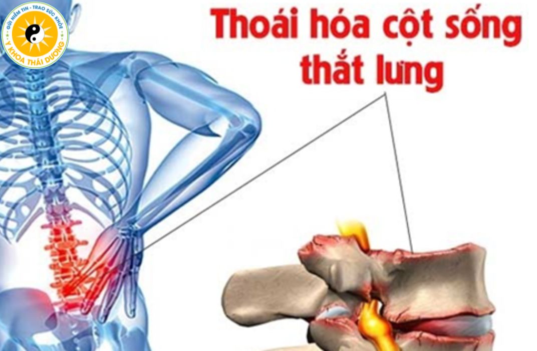 Thoái hóa cột sống thắt lưng và cổ: Triệu chứng và cách điều trị