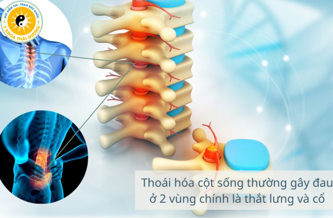 Thoái hóa khớp - cột sống: Nhận biết sớm và phác đồ điều trị hiện nay