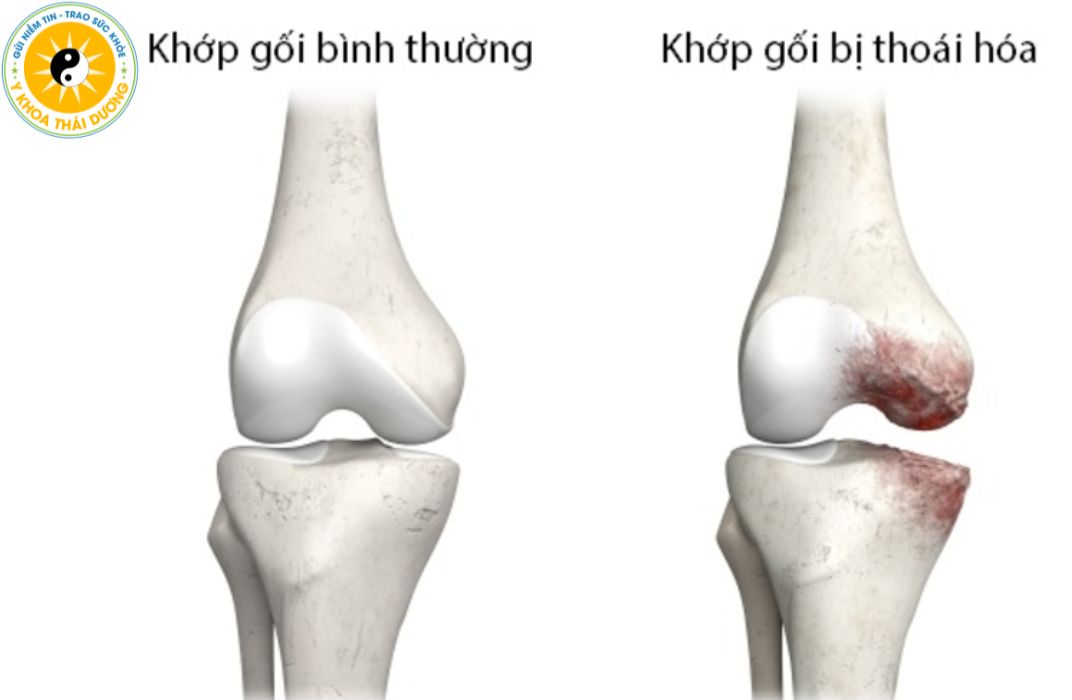 4. Riêng về thoái hóa khớp gối: Biểu hiện rõ rệt và phổ biến