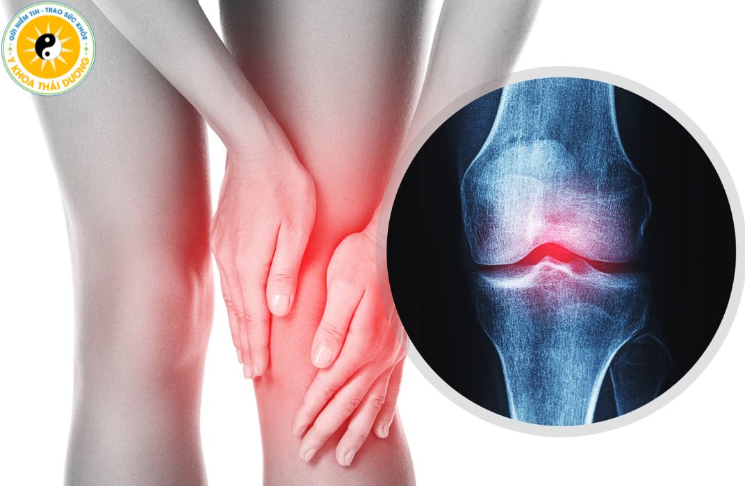 Thoái hóa khớp gối: Nguyên nhân, biểu hiện và hướng điều trị
