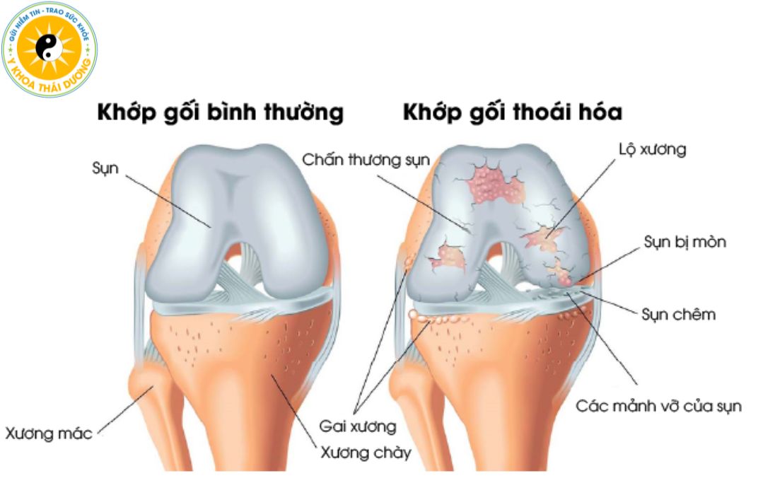 Thoái hóa khớp gối: Nguyên nhân, biểu hiện và hướng điều trị
