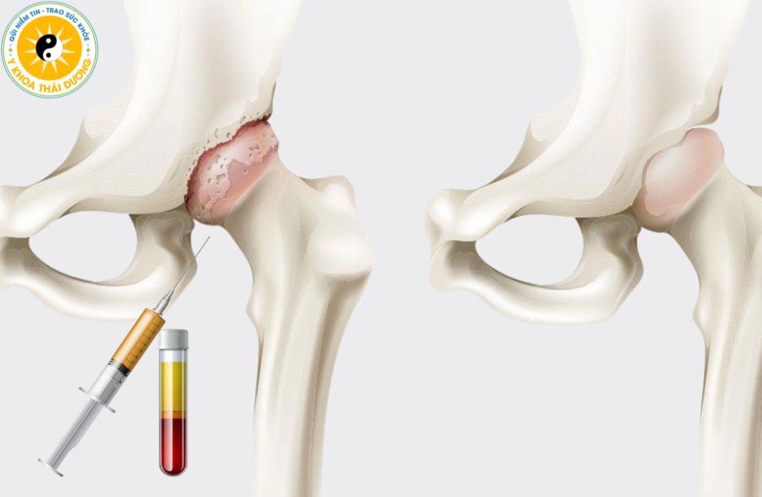 Thoái hóa khớp háng: Khi nào cần can thiệp y khoa?