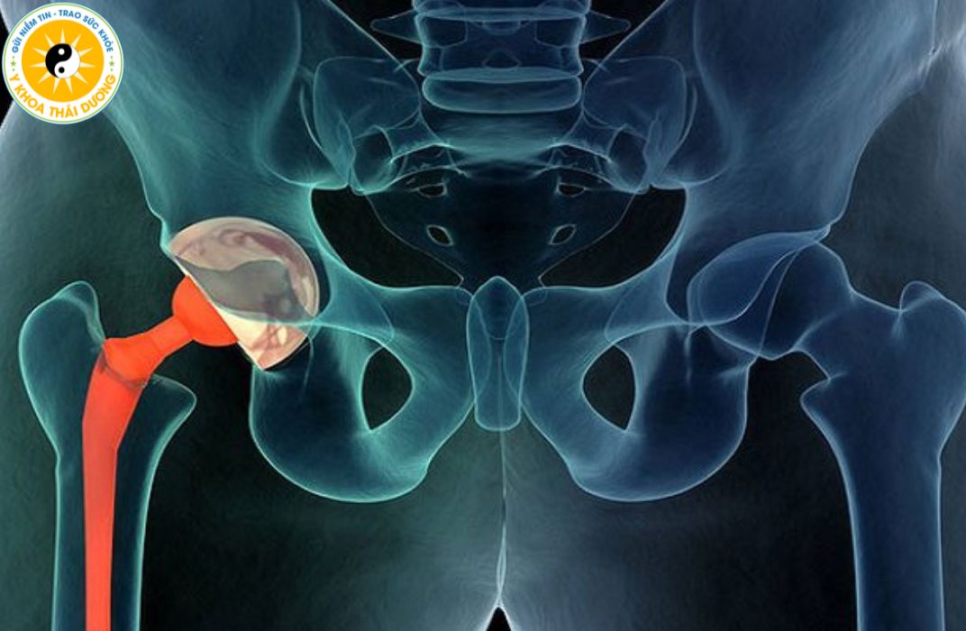 Thoái hóa khớp háng: Khi nào cần can thiệp y khoa?