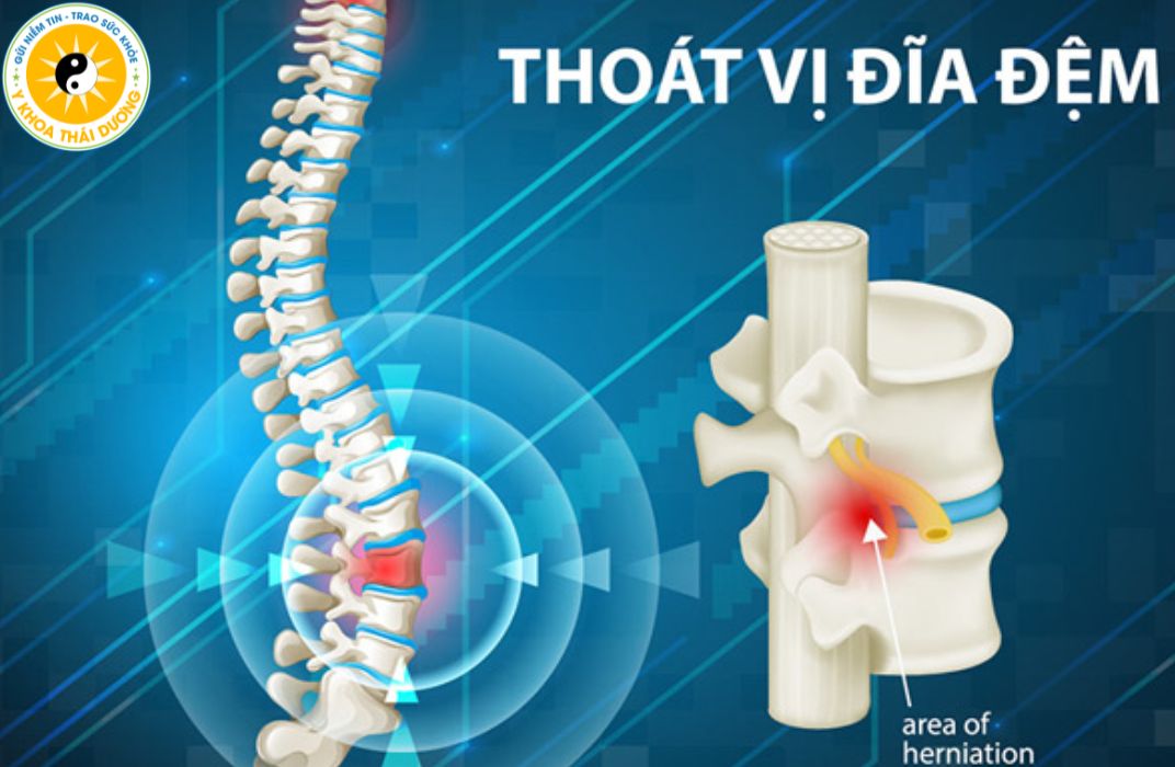 Đau lưng bên trái là bệnh gì? Khi nào cần đi khám?